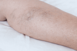 sclerotherapy vein treatment miami & florida