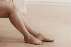 spider vein treatment miami
