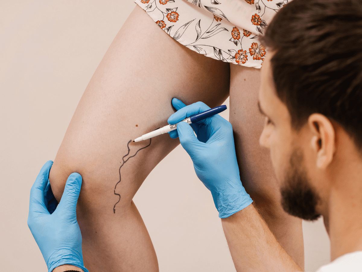 varicose vein treatment in coral gables