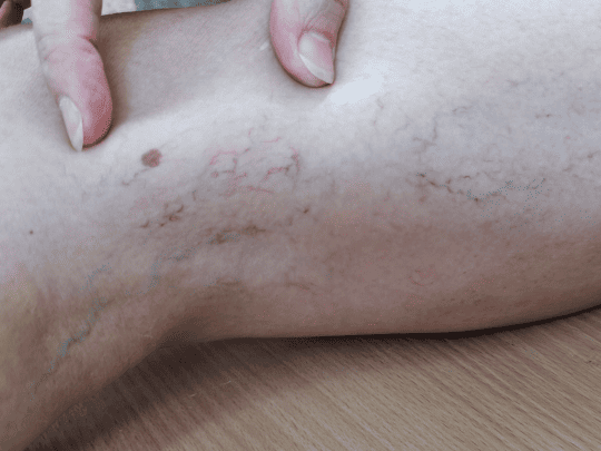spider veins treatment with sclerotherapy in coral gables