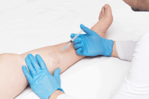 VenaCure EVLT treatment for varicose veins in Coral Gables.