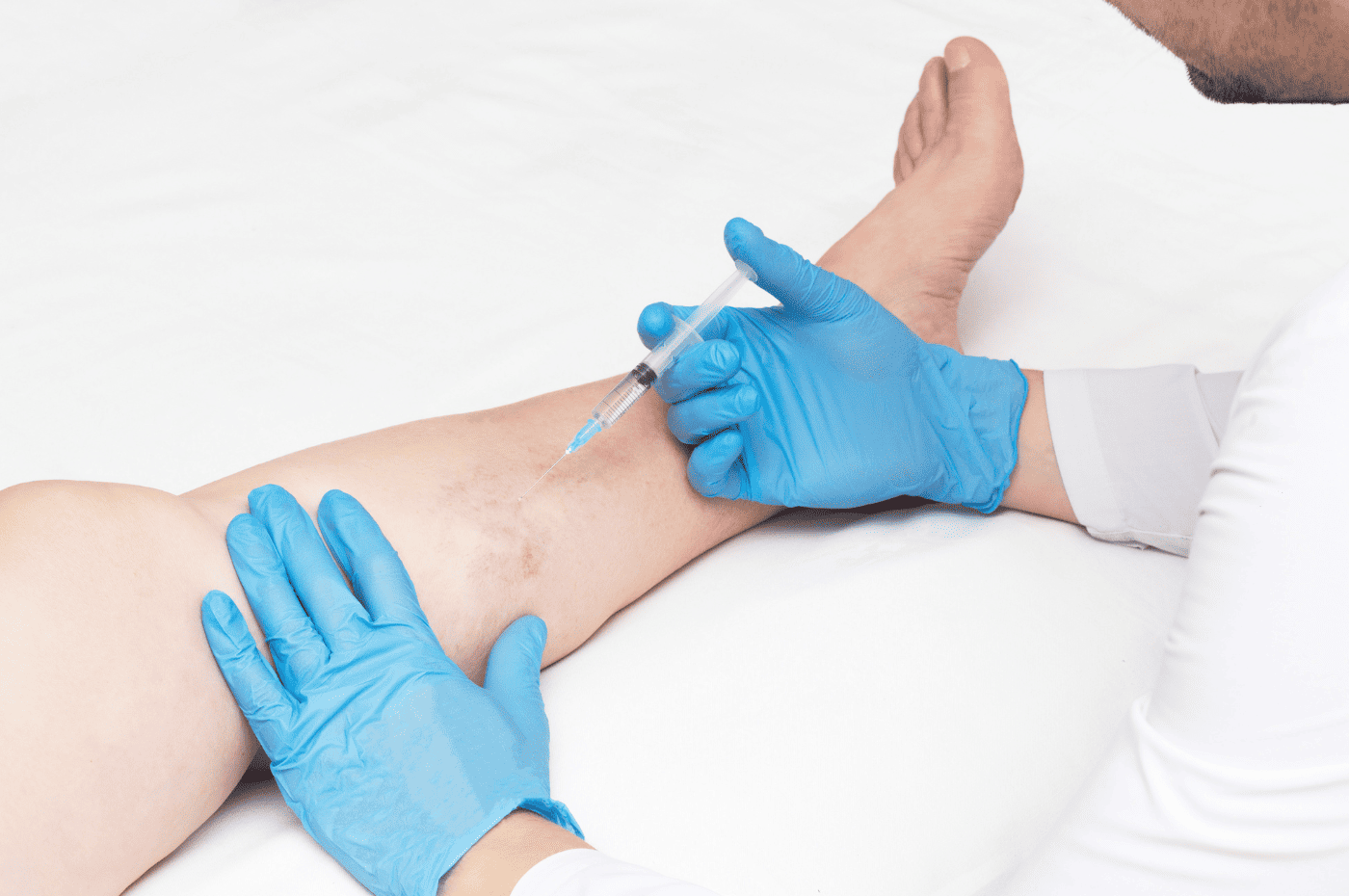 VenaCure EVLT treatment for varicose veins in Coral Gables.