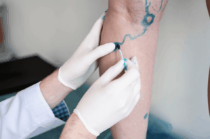 Spider vein treatment for face and legs at Miami Vein Institute in Coral Gables.